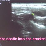 Fascia Release Treatment for shoulder stiffness