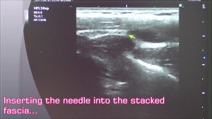 Fascia Release Treatment for shoulder stiffness